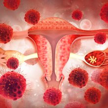 CBD & Cannabis for Endometriosis